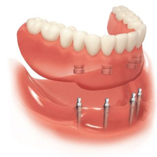 Denture Retentive System