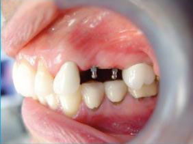 Mini Dental Implant - Step Two